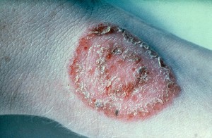 view Human ringworm: single lesion on the arm.