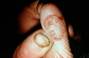 view Pseudo cowpox lesion on a cow's teat, with