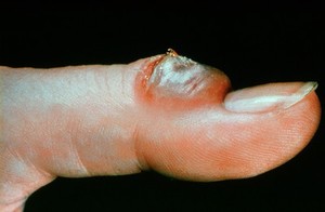 view Lesion of orf and milker's nodes in man