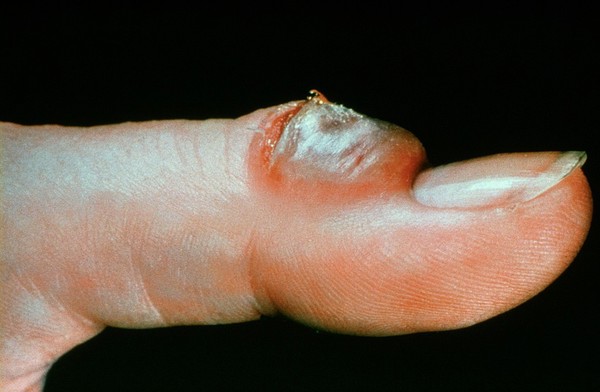 Lesion of orf and milker's nodes in man