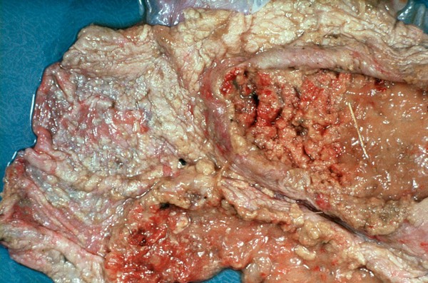 Severely infected bovine placenta