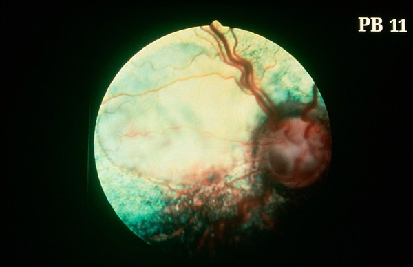 Canine fundus - coloboma & retina detachment