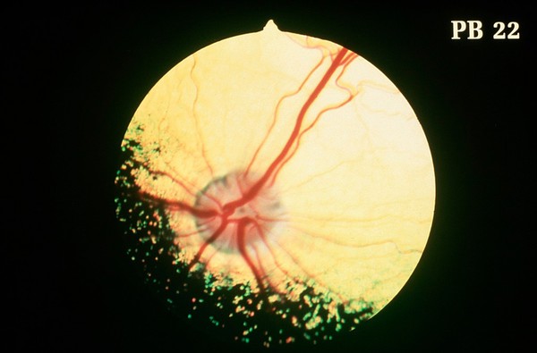 Canine eye: a normal fundus