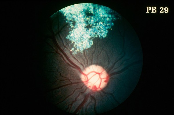 Canine eye: a normal fundus