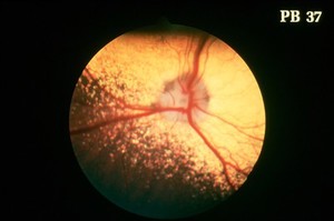 view Canine eye: a normal fundus of a Miniature Poodle.