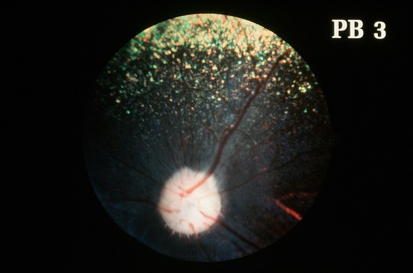 Canine retina: fundus with early retinitis