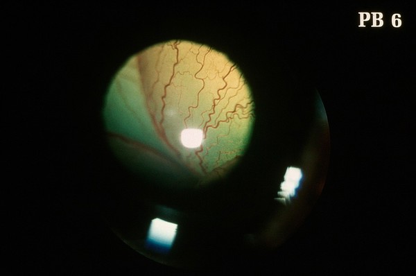 Canine retinal detachment, chorio-retinitis