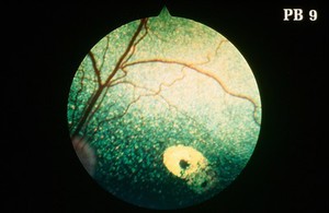 view Canine retina: focal retinopathy