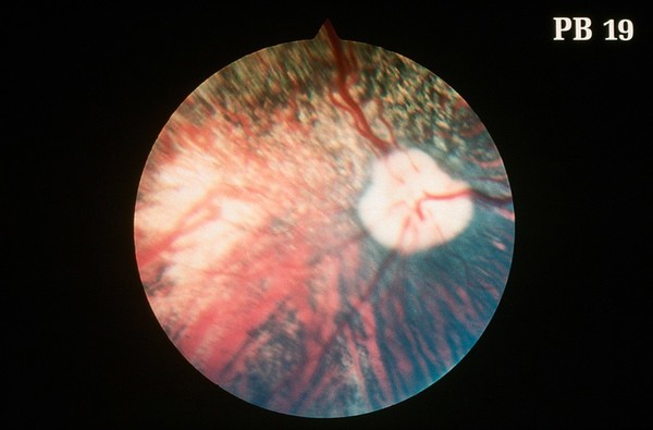 Canine retina: choroidal hypoplasia