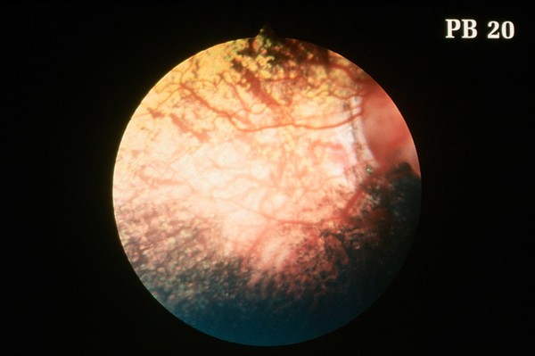 Canine retina: choroidal hypoplasia