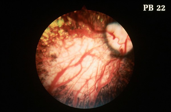 Canine retina: choroidal hypoplasia