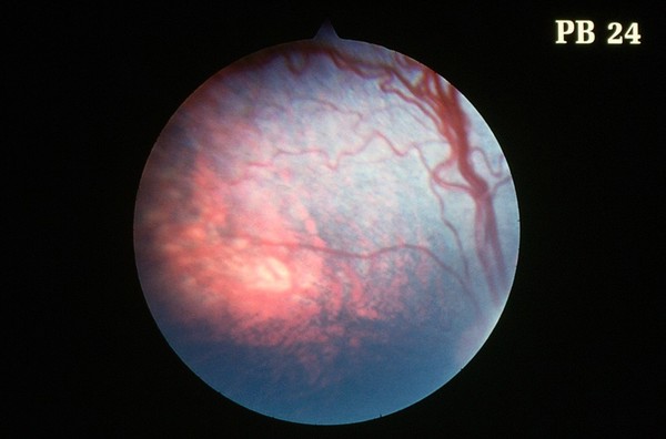 Canine retina: choroidal hypoplasia