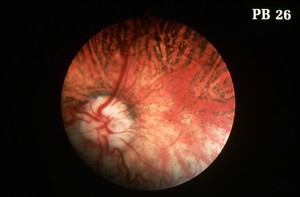 view Canine retina: choroidal hypoplasia