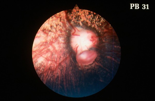 Typical peripapillary coloboma, right fundus