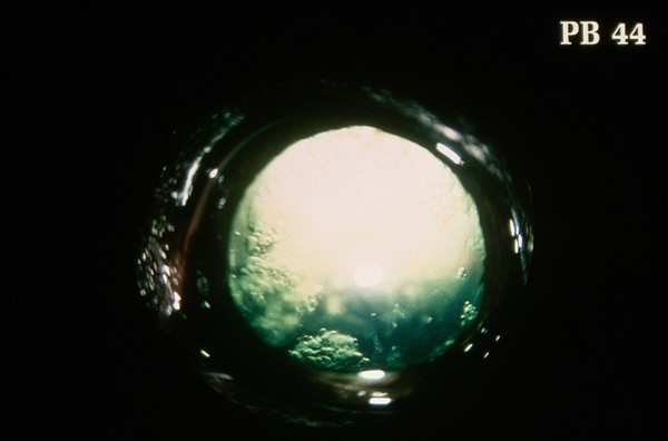 Canine retina: early cataract formation