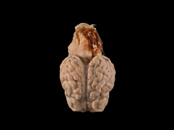 Tapeworm cyst in a sheep brain