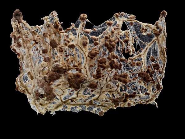 Metastatic neoplasia of omentum tissue, canine