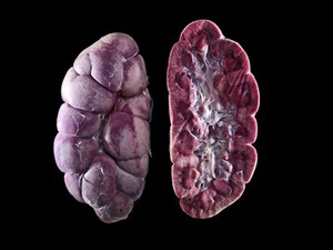 view Acute nephritis in calf kidneys