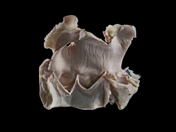 Aortic valvular endocarditis, horse. This equine (horse) aorta has been dissected at the level of the valve, separating the artery from the left ventricle (bottom chamber). Nodules are present which have formed as a consequence of endocarditis. 
