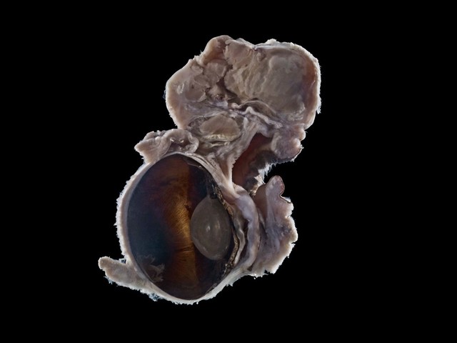 Squamous cell carcinoma, mouse eye