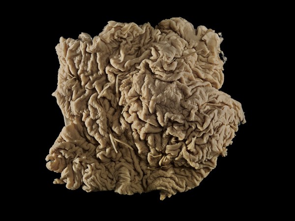 Horse intestine with multiple attached parasitic worms