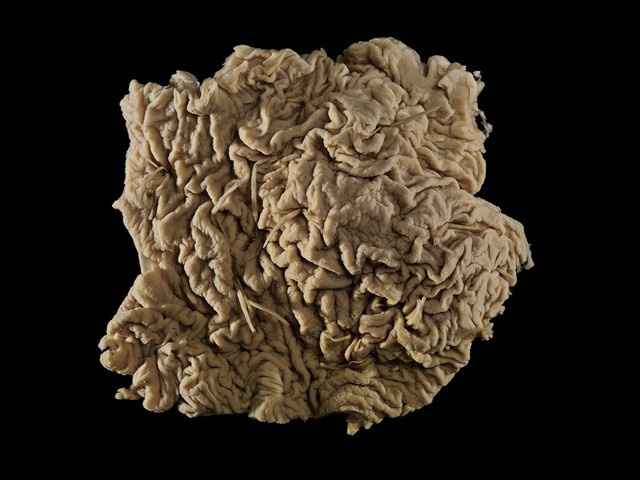Horse intestine with multiple attached parasitic worms