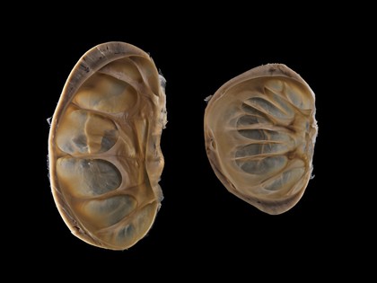 Kidneys showing bilateral atrophy (tissue wasting)