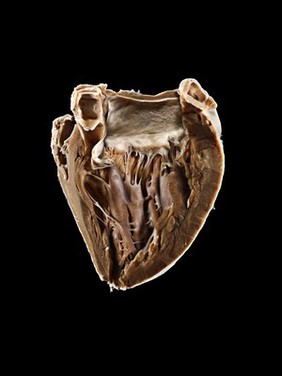 Acute Rheumatic Vegetations on Mitral Valve