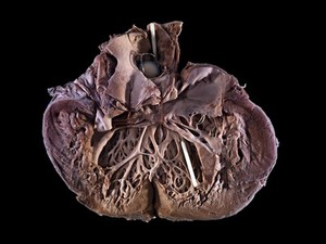 view Aortic Valve Replacement