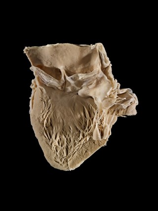 Bicuspid Aortic Valve