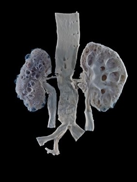 Cystic Kidneys with Bilateral Pyonephrosis