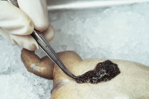 view Xenopus frog egg removal, eggs on belly