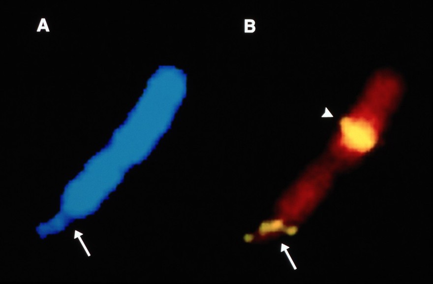 Fragile X chromosome, various stains
