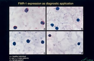 view Diagnostic test for Fragile X, using presence (normal) or absence (Fragile X syndrome) of FMR-1 protein. FMR-1 protein expression in blood cells has been made visible with antibodies against the FMR-1 protein. The presence of FMR-1 protein is made visible as red staining. a: red staining in cells of normal individual. b/c: absence of staining in male patient. d: female patient; one cell is showing staining and in the other cell there is an absence of staining - this individual is a carrier.