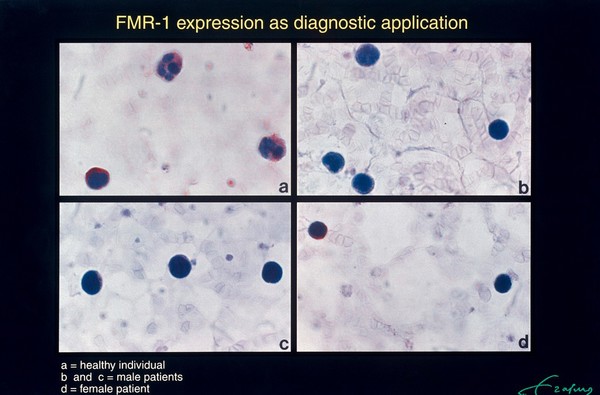 Diagnostic test for Fragile X, using presence (normal) or absence (Fragile X syndrome) of FMR-1 protein. FMR-1 protein expression in blood cells has been made visible with antibodies against the FMR-1 protein. The presence of FMR-1 protein is made visible as red staining. a: red staining in cells of normal individual. b/c: absence of staining in male patient. d: female patient; one cell is showing staining and in the other cell there is an absence of staining - this individual is a carrier.