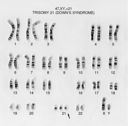 Down syndrome human karyotype 47,XY,+21