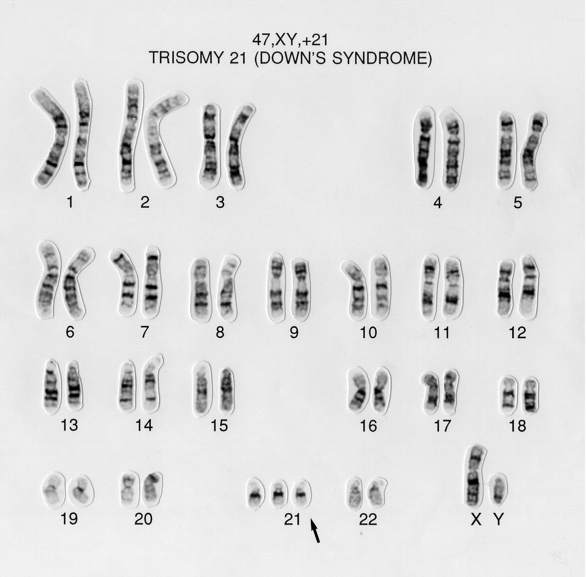 International Mosaic Down Syndrome Association Explaining Karyotypes