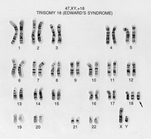 view Edward's syndrome karyotype, 47,XY,+18