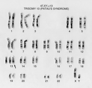 Patau's syndrome karyotype 47,XY,+13