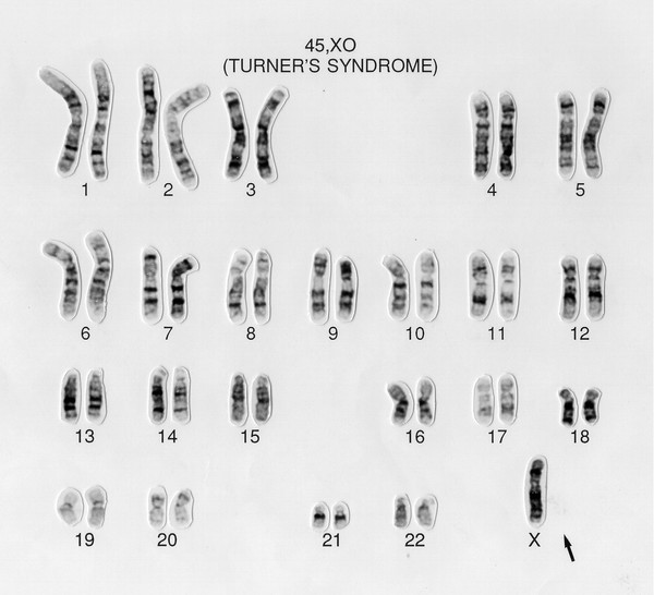 Turner's syndrome karyotype 45,XO. This female lacks the second X chromosome present in the normal karyotype. Symptoms include short stature, neck wbbing, elbow deformity, widely spaced nipples with shield chest, primary amenorrhea, sexual infantilism and sterility. The ovaries are reduced to fibrous streaks. Also known as XO syndrome or ovarian short-stature syndrome.