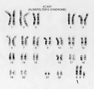 view Klinefelter's syndrome karyotype 47,XXY