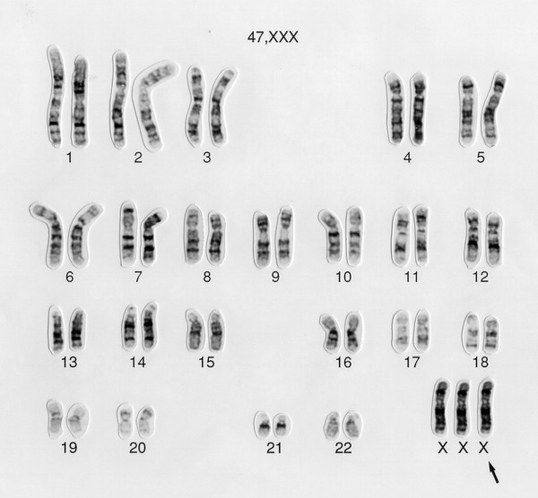 Triple-X chromosome aberration karyotype