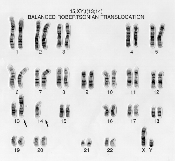 Balanced translocation 45,XY,t(13;14)