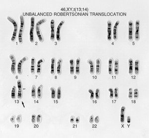 view Unbalanced translocation 46,XY,t(13;14)