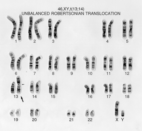 Unbalanced translocation 46,XY,t(13;14)