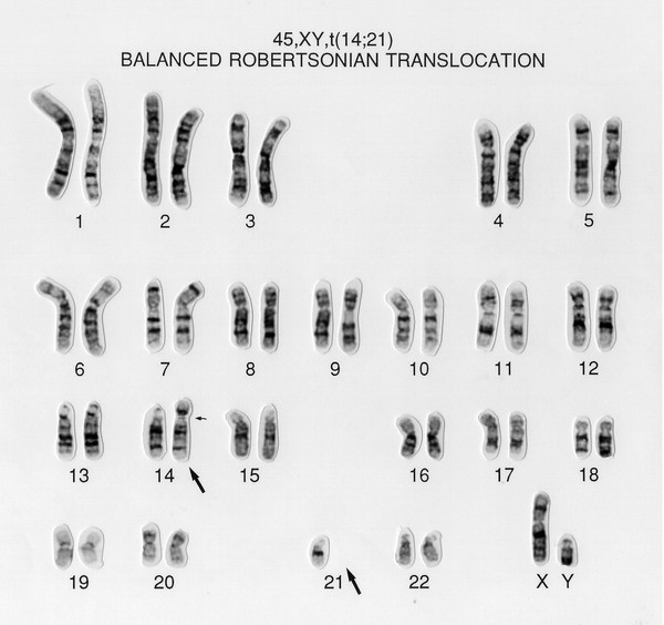 Balanced translocation 45,XY,t(14;21)