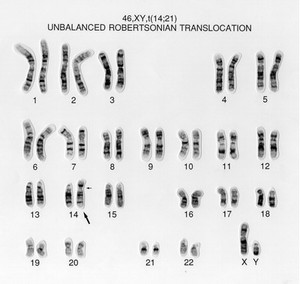 view Unbalanced translocation 46,XY,t(14;21)