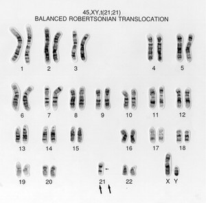 view Balanced translocation 45,XY,t(21;21)