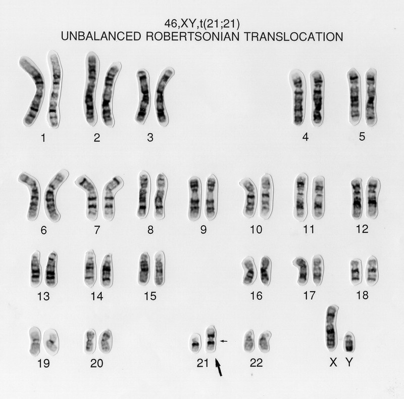 unbalanced-translocation-46-xy-t-21-21-wellcome-collection