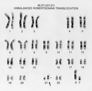 view Unbalanced translocation 46,XY,t(21;21)